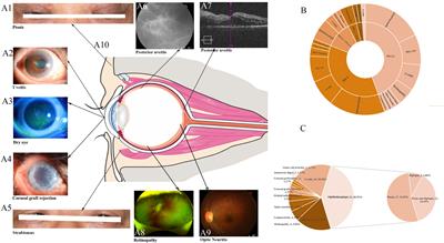 Ocular Immune-Related Adverse Events Associated With Immune Checkpoint Inhibitors in Lung Cancer